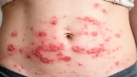 alergia pokarmowa wysypka na brzuchu